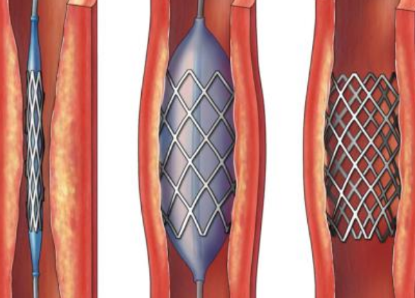 好消息！700元冠脈支架來(lái)了帶量采購(gòu)結(jié)果在甘肅省正式落地執(zhí)行
